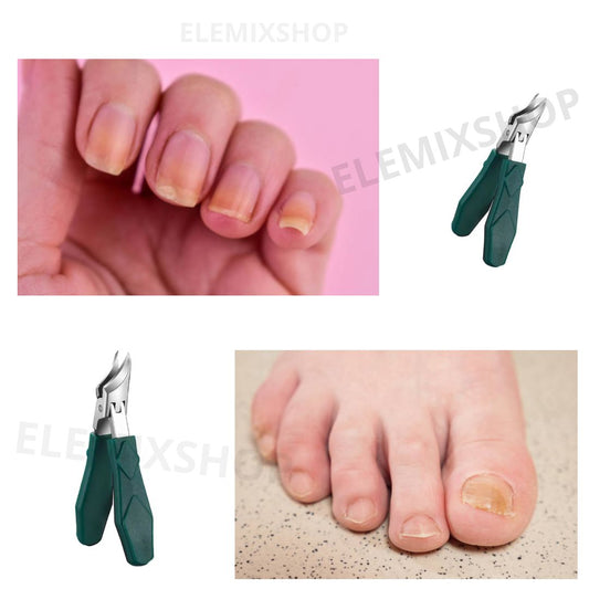 Adiós uñas encarnada